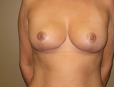 Patient # 54028 After Photo # 2